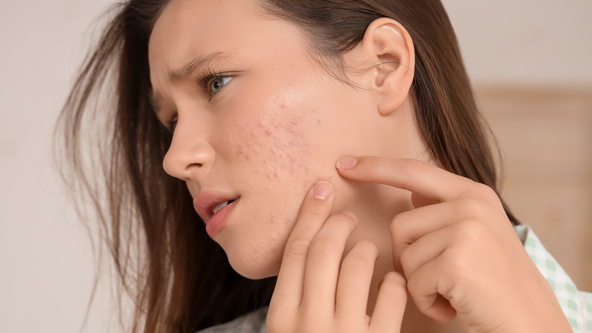 The Ultimate Step-by-Step Daily Routine to Prevent Stress Acne