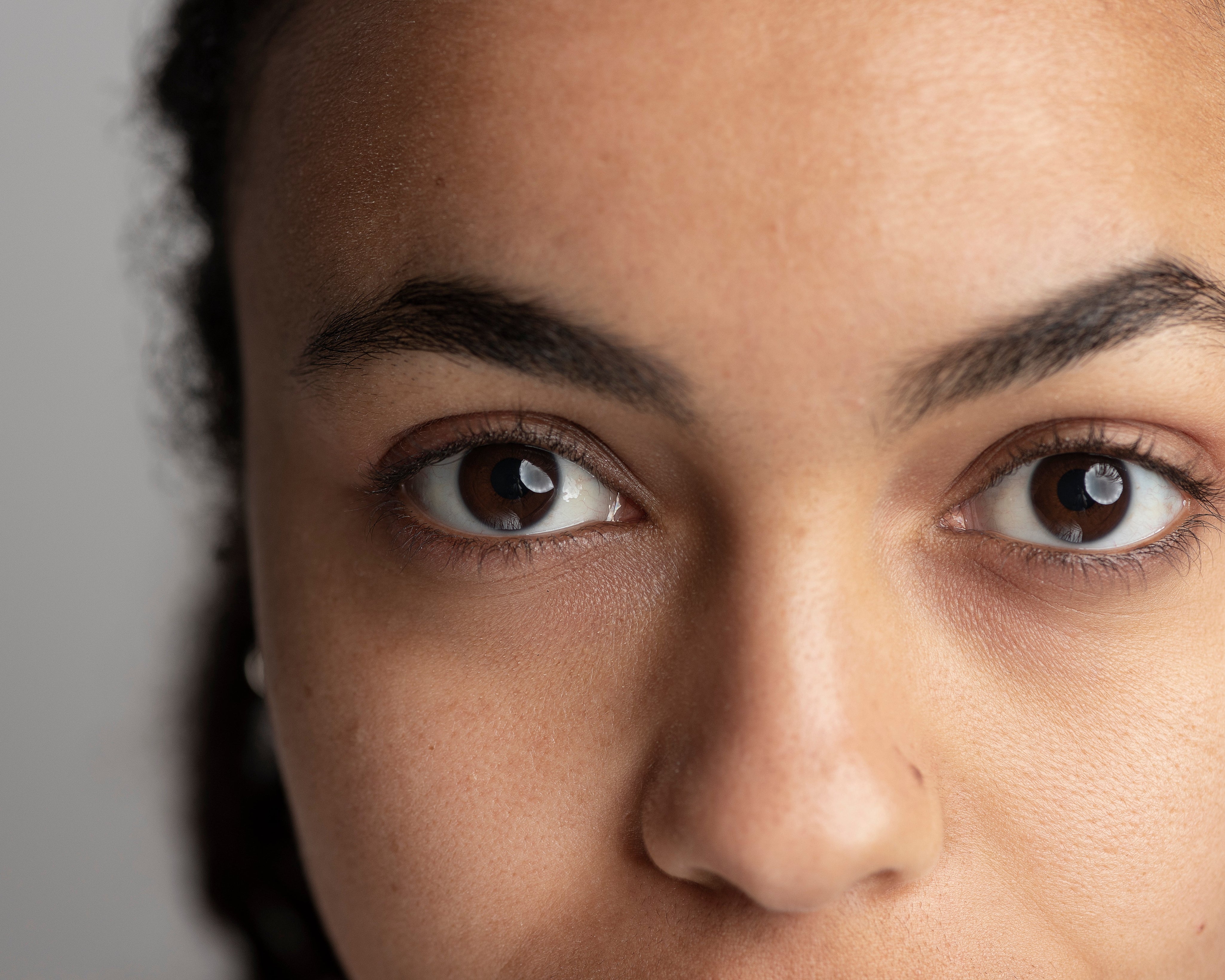 How to Remove Dark Circles Caused by Stress: Expert Tips and Skyn Iceland Solutions