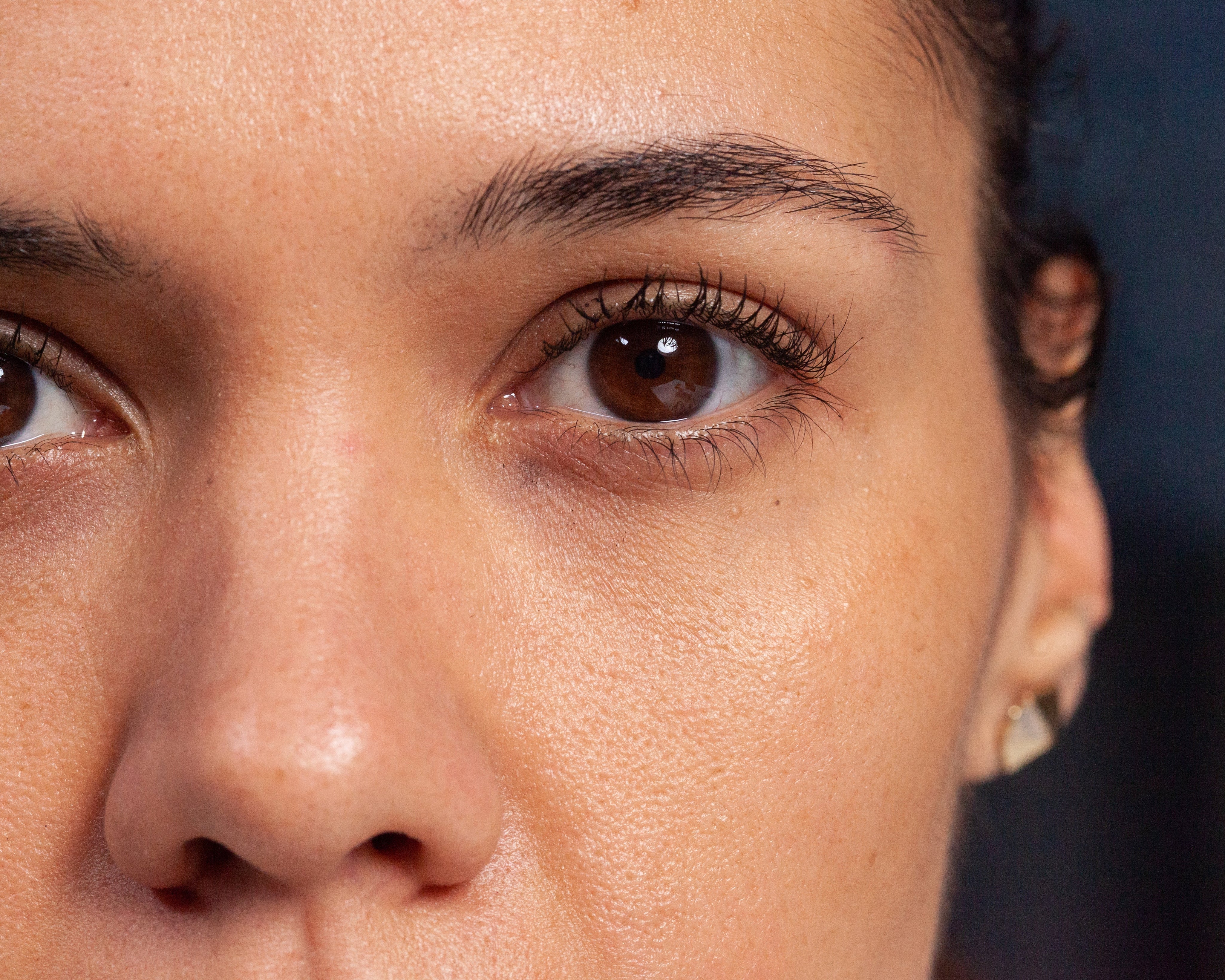 Decoding Dark Circles: How to Tell if Yours Are Vascular or Pigmented (And How to Fix Them)