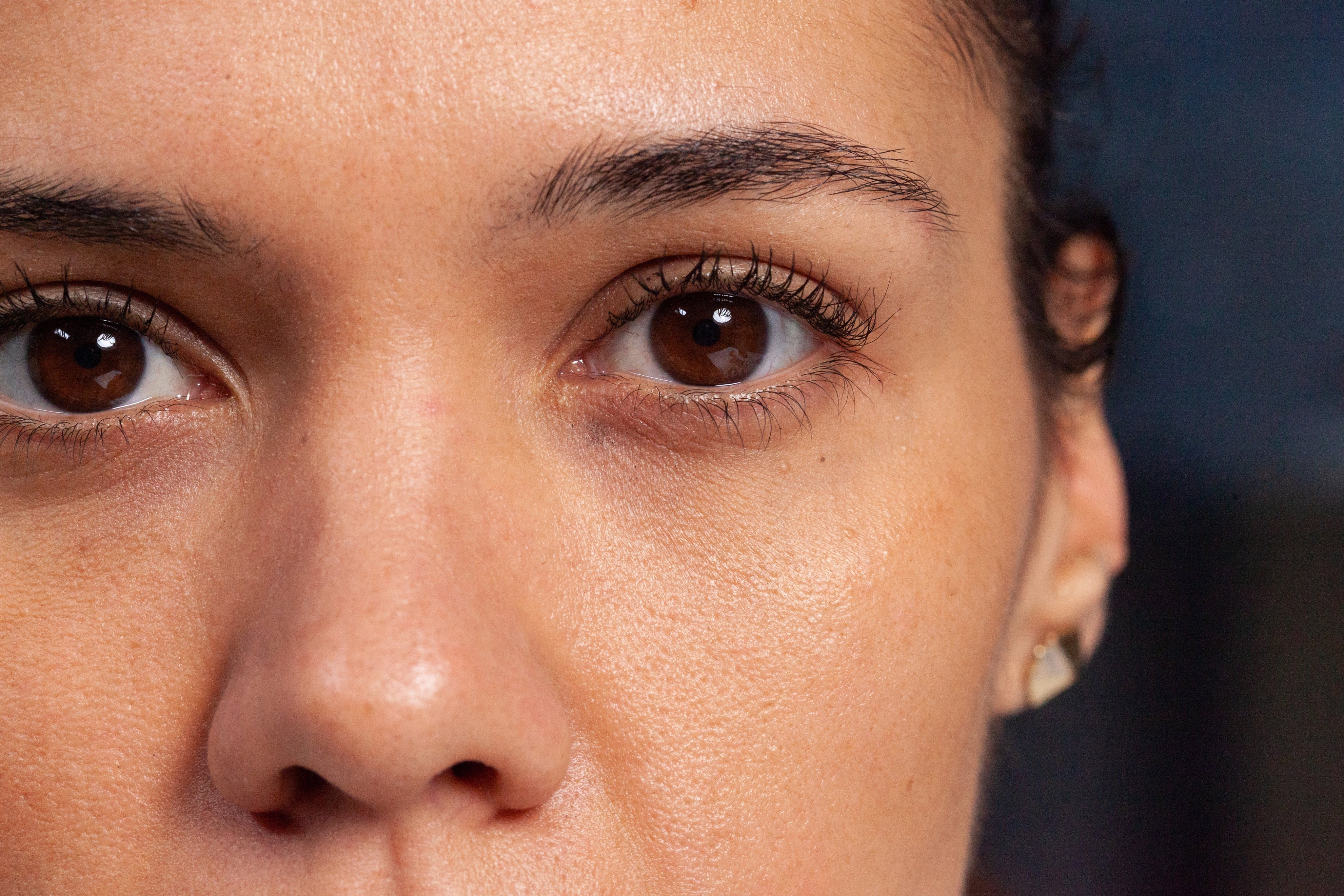 Decoding Dark Circles: How to Tell if Yours Are Vascular or Pigmented (And How to Fix Them)