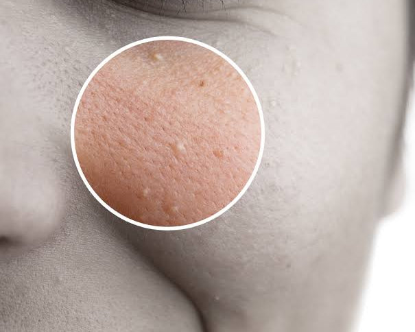 The Ultimate Guide to Milia: Identifying, Treating, and Preventing Under-Eye Bumps