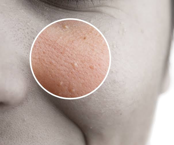 The Ultimate Guide to Milia: Identifying, Treating, and Preventing Under-Eye Bumps