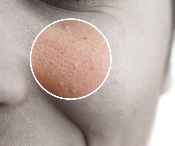 The Ultimate Guide to Milia: Identifying, Treating, and Preventing Under-Eye Bumps