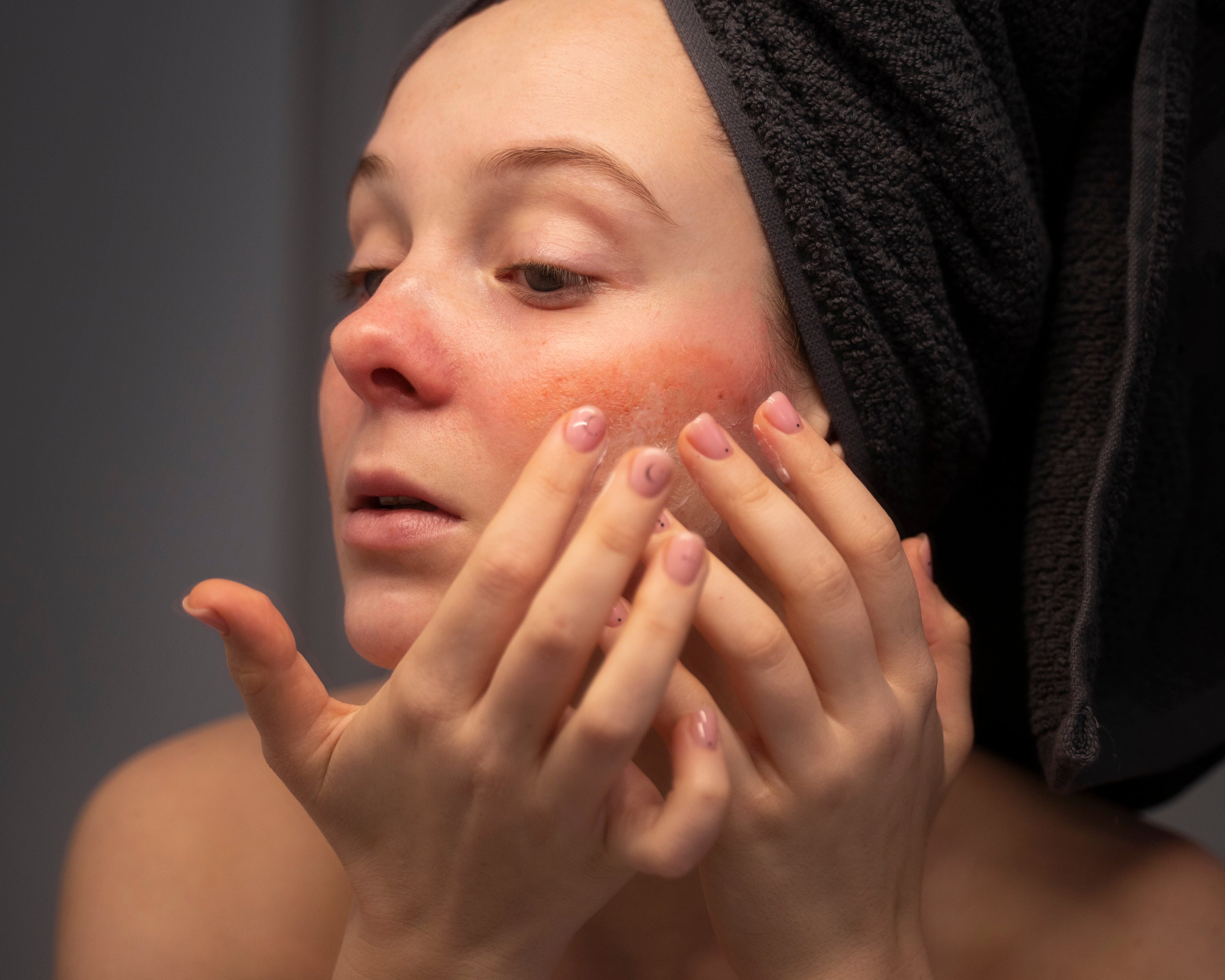 How to Soothe Dry Patches on Your Face in Winter: Expert Tips and Skyn Iceland Solutions