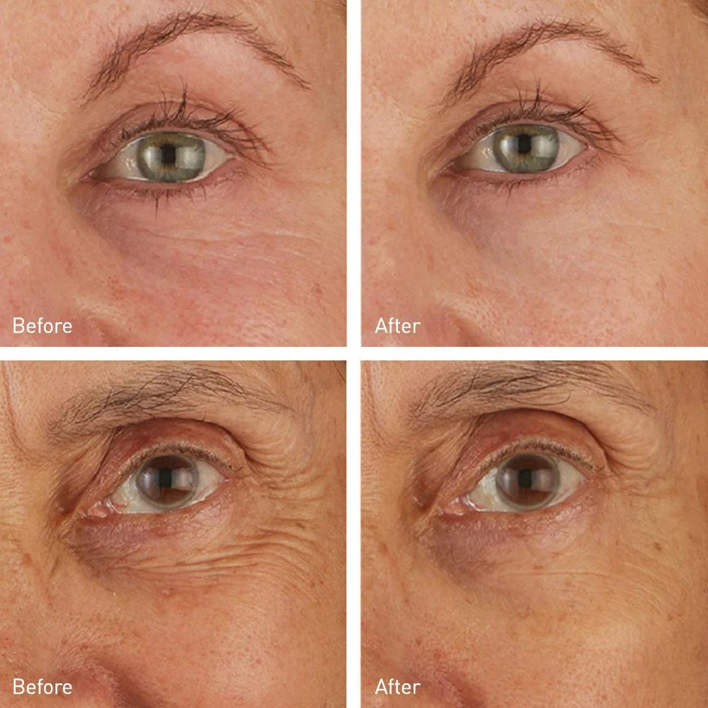 Before and After using Hydro Cool Firming Eye Gels - Visible reduction in puffiness and fine lines under the eyes, with improved hydration and firmness, thanks to Icelandic glacial water, peptides, and antioxidants - Skyn Iceland